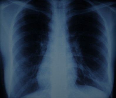 pneumologie-radiographie-thorax-opacite-interstitielle-pI9SRvAQMk.jpg
